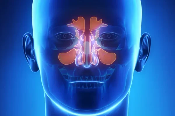 Top Causes of Chronic Sinusitis in American Adults