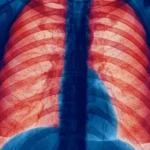Key Factors That Worsen Chronic Obstructive Pulmonary Disease