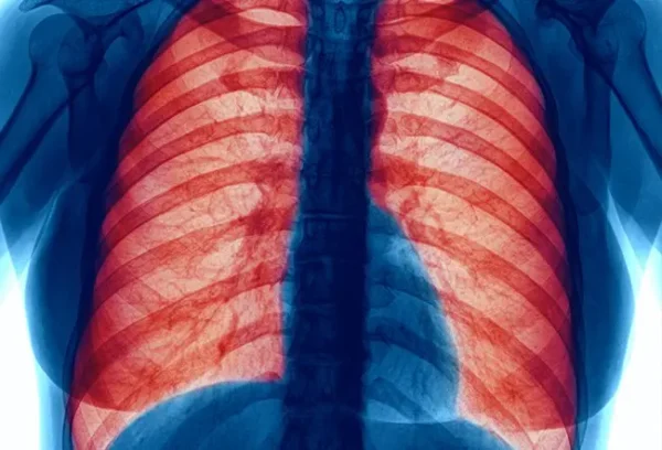 Key Factors That Worsen Chronic Obstructive Pulmonary Disease