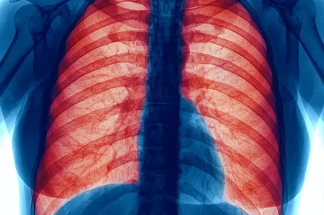 Key Factors That Worsen Chronic Obstructive Pulmonary Disease