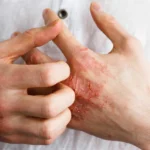 Best Ways to Manage Eczema Naturally Without Steroids