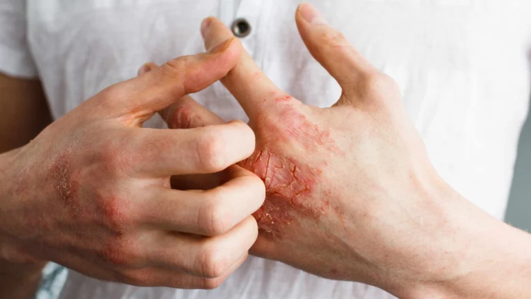 Best Ways to Manage Eczema Naturally Without Steroids